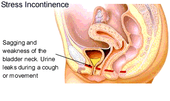 Urinary Incontinence, Grimaldi Center, Dr. Grimaldi